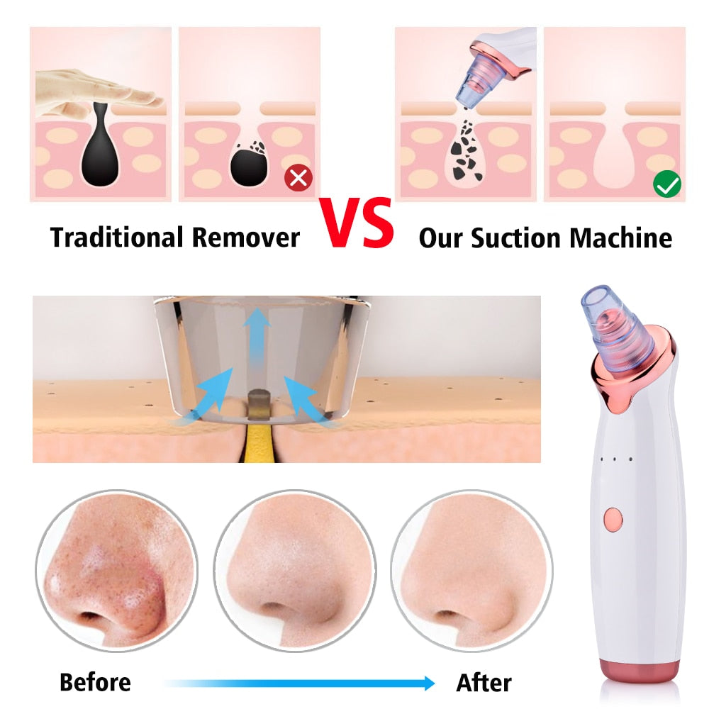 جهاز شفط الرؤوس السوداء الكهربائي لغسيل الوجه | Blackhead Instrument Electric Suction Facial Washing
