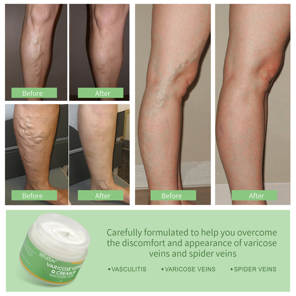 كريم علاج الدوالي والأوردة بالزعفران | Varicose Vein Cream Safflower 50g
